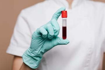 Exame de sangue pode diagnosticar Alzheimer precocemente 3 Hemolab Exame de Sangue